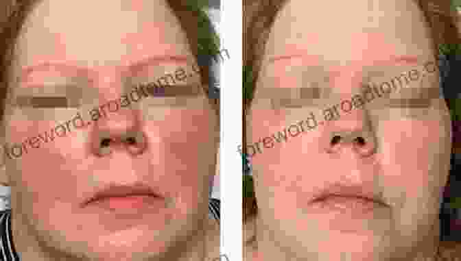 A Woman With Rosacea Before And After Using The Natural Cure Curing Rosacea In 3 Easy Steps Stop Feeling Uncomfortable About Your Skin : Cure Rosacea In 2 Weeks Or Less In Most Cases Dermatologist Don T Want You To Get This