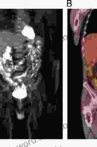 PET/CT for Inflammatory Diseases: Basic Sciences Typical Cases and Review